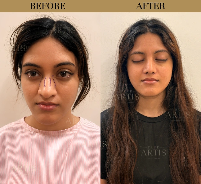 Before After