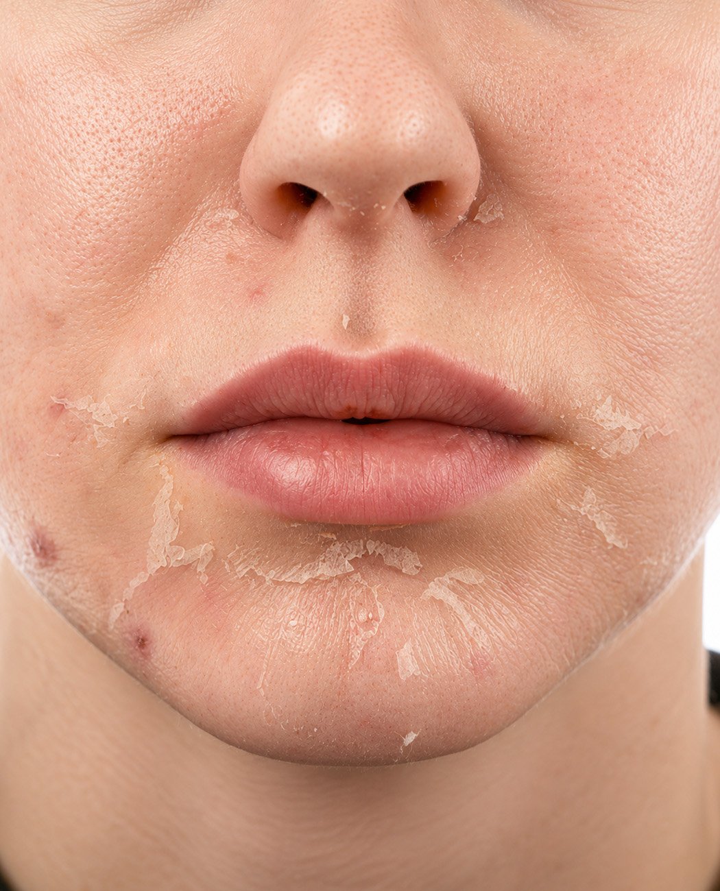 How is the chemical peel treatment performed?