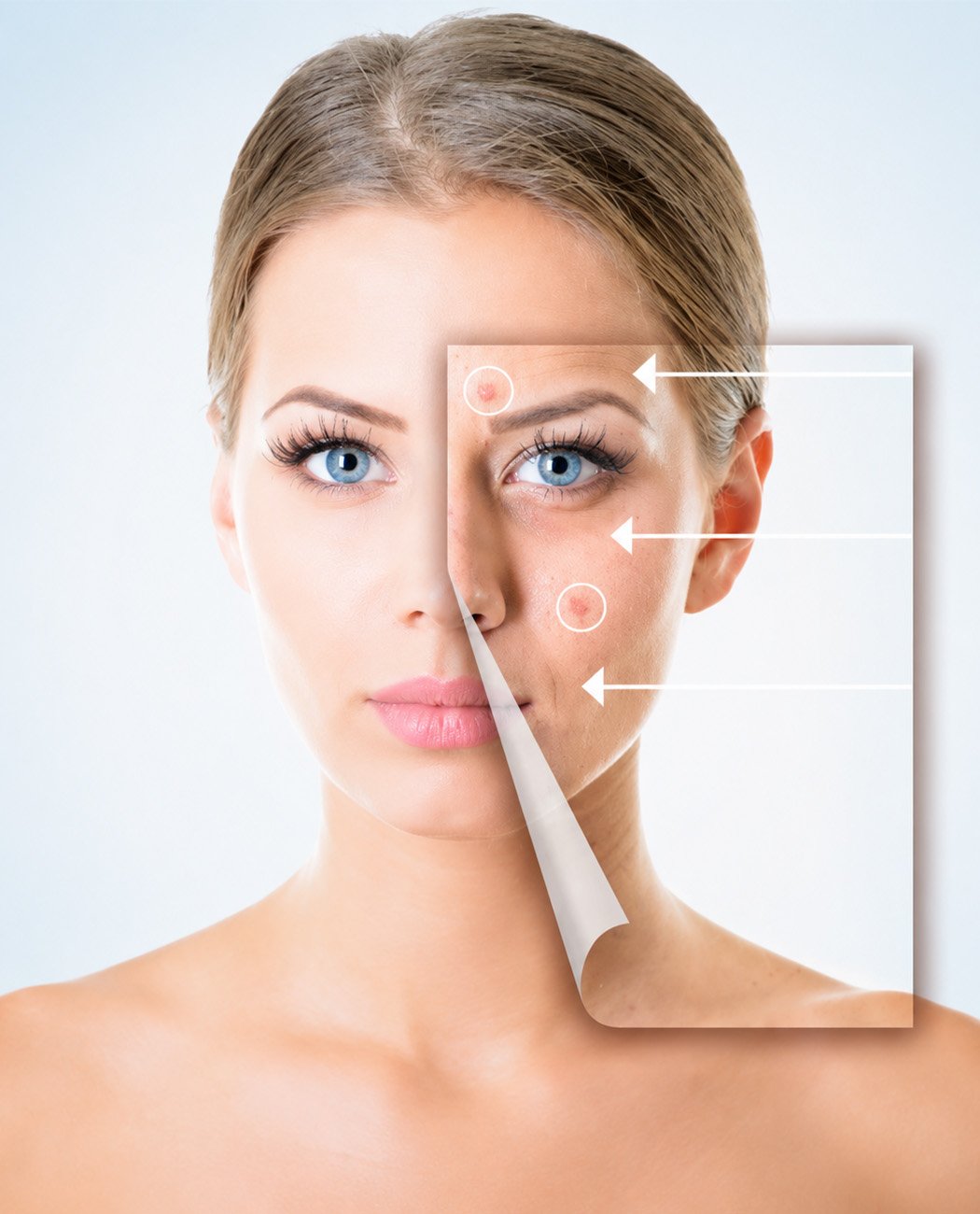 How is Laser Skin Resurfacing treatment performed?