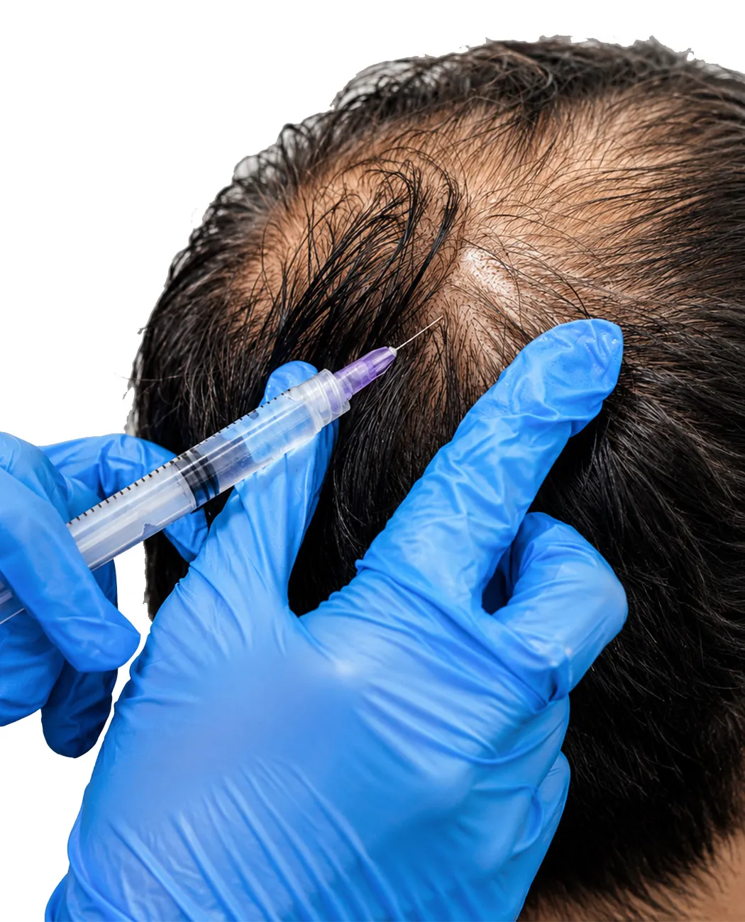 How is PRP Therapy Performed?