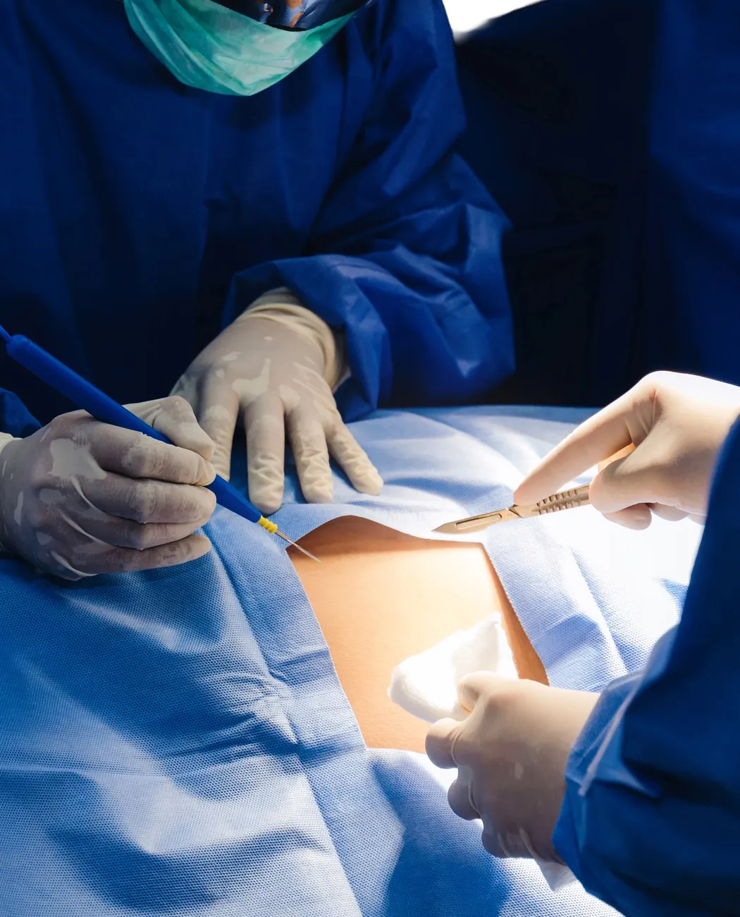 How is Liposuction Surgery Performed?