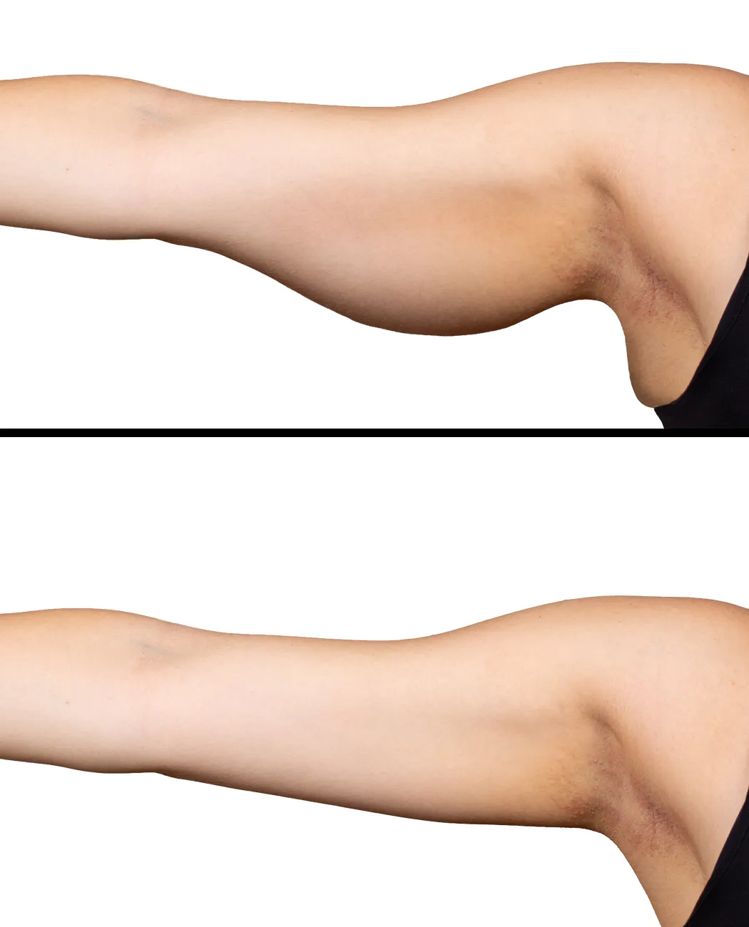 Who is an Ideal Candidate for an Arm Lift Surgery?