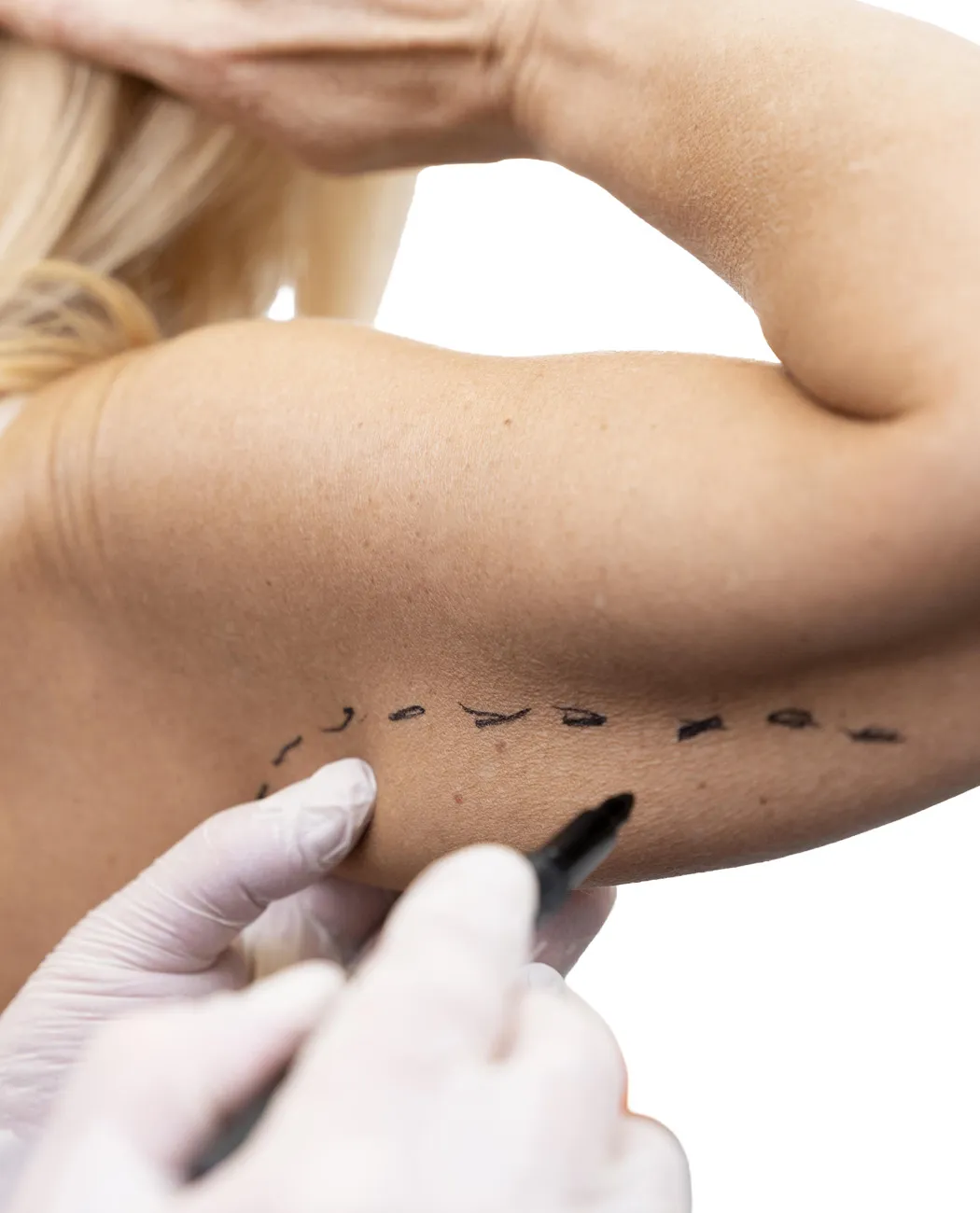 How is Arm Lift Surgery Performed?