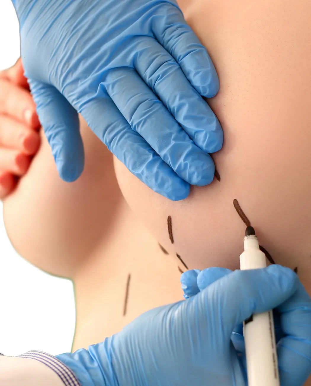 Recovery After Nipple Correction Surgery: What to Expect