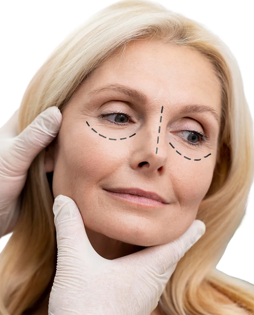 How is Blepharoplasty surgery performed?