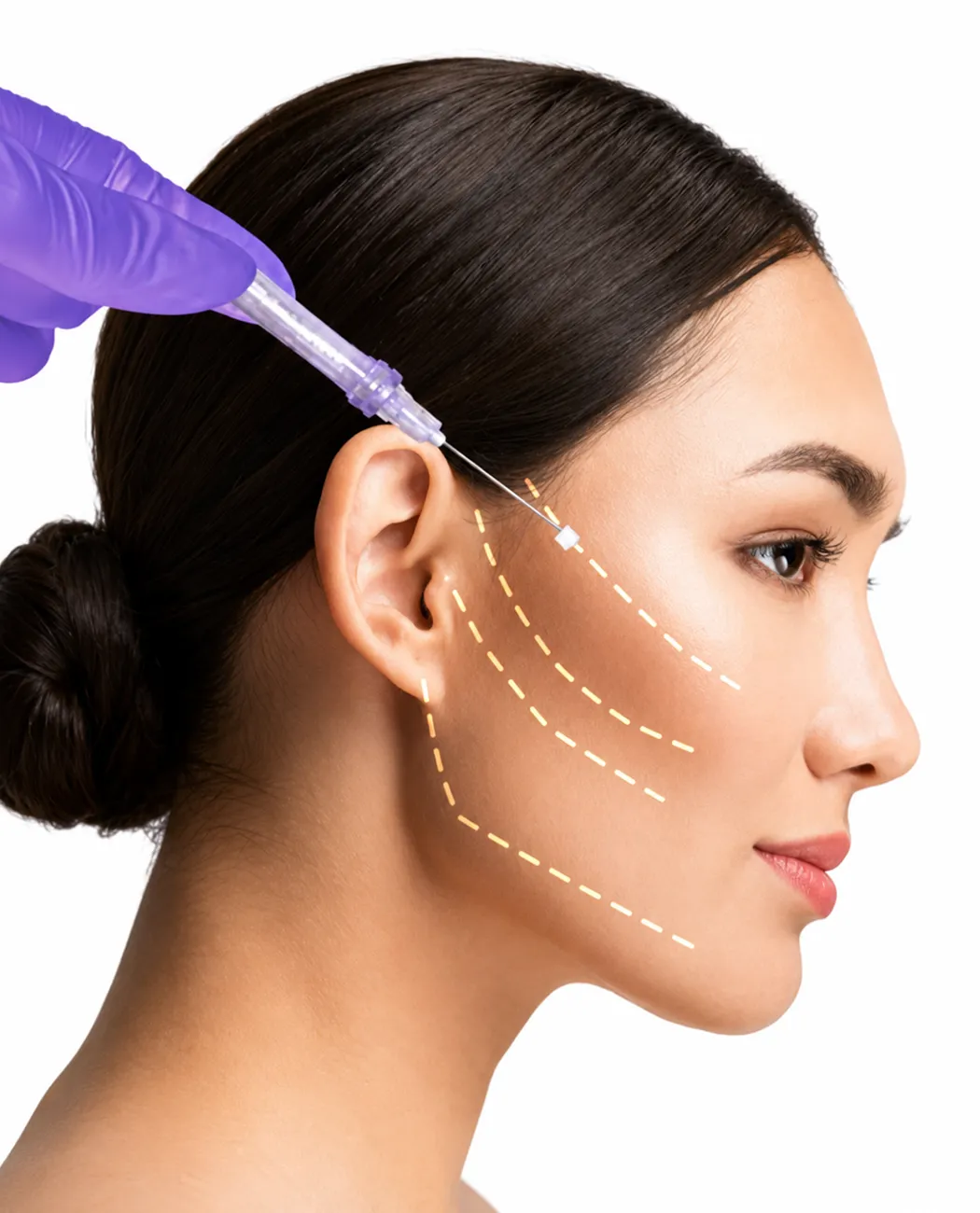 What is Thread Lift Surgery?