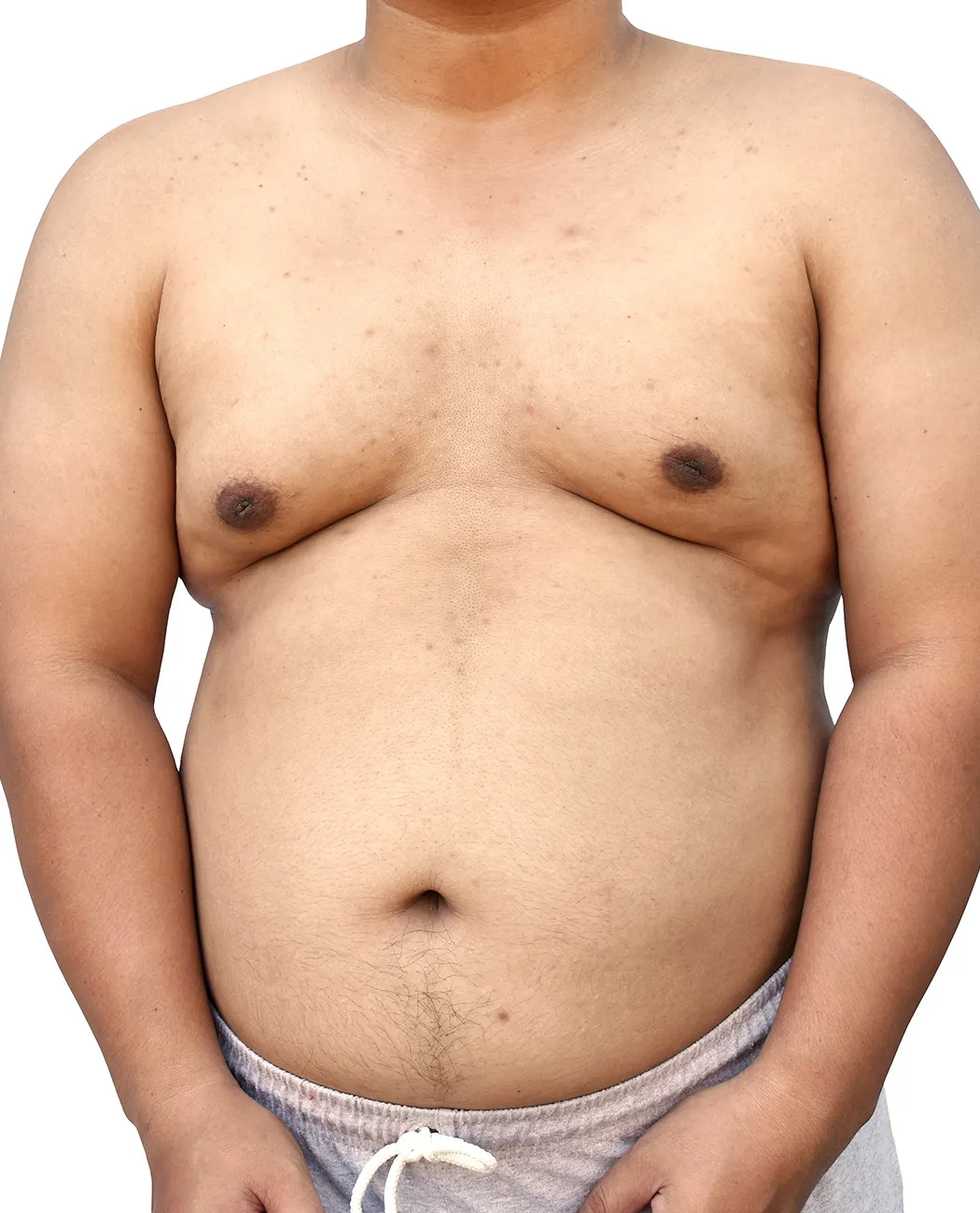 What is Gynecomastia Surgery?
